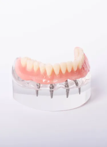 Dental Implants at Elwell Family Dentistry in Canton, Georgia